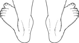 pediatric flatfoot